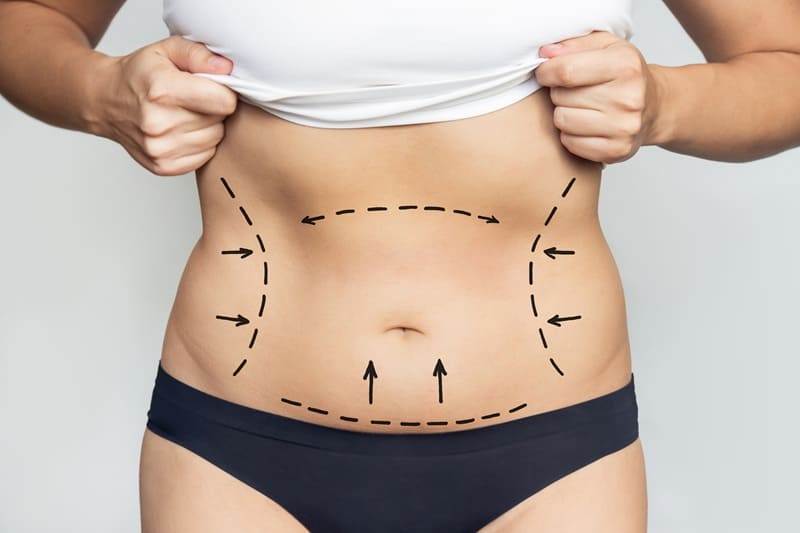 Abdominoplastia en Mazatlán, México